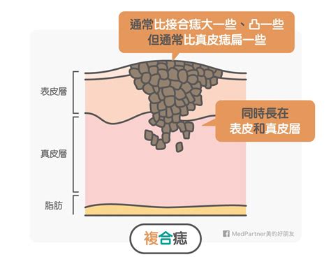 點痣 流血|點痣，原來這麼簡單－萊茵診所